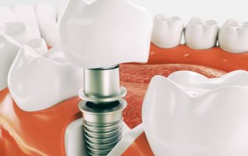 The Life-Changing Benefits of Oral Implants in Balwyn